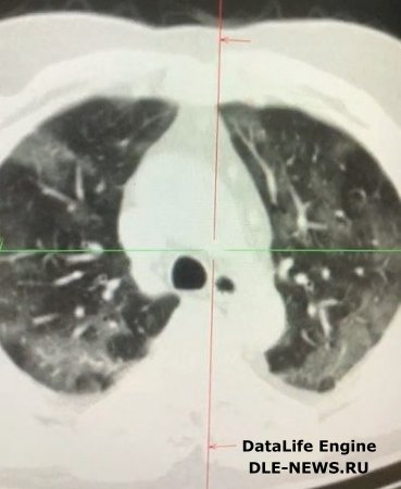 Koronavirus 50 yaşlı azərbaycanlı qadının ağciyərlərini bu hala saldı - FOTO